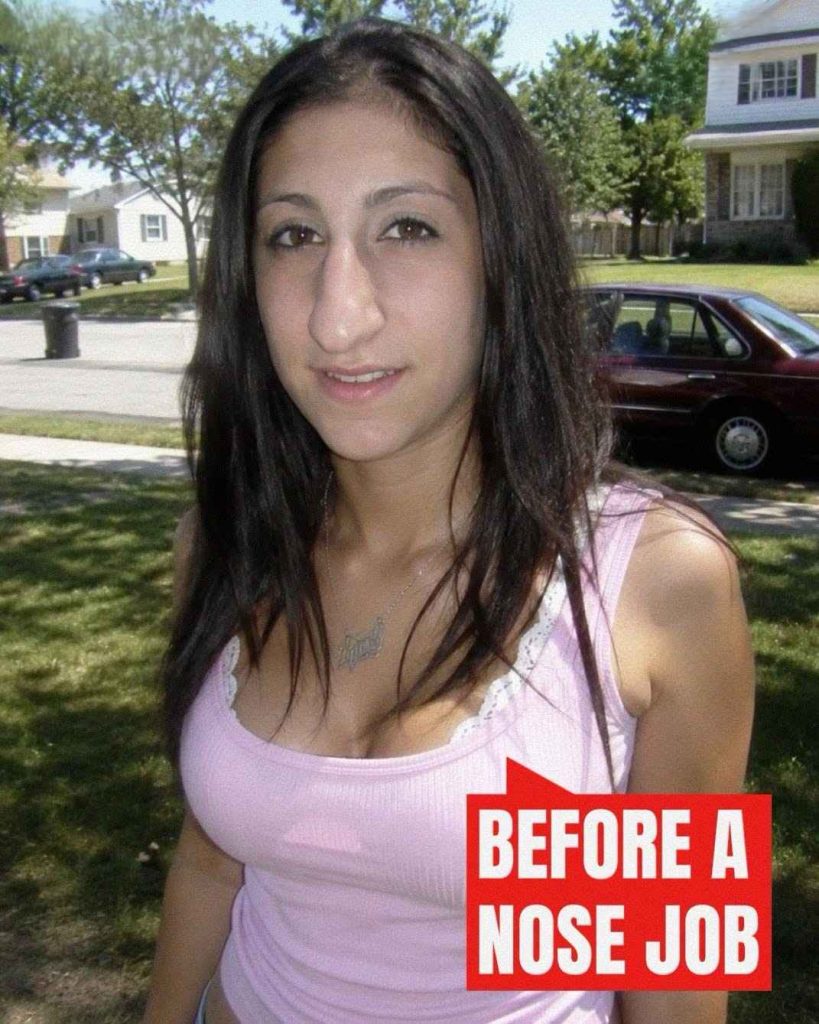 I Got a N0se Job After Years of Being Bullied… When I Came Home, My Husband Had Removed Every Mirror
