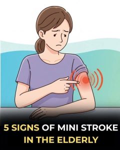 ministroke